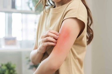 Besin Alerjileri ve İntoleransları: Beslenme Planınızı Nasıl Uyarlarsınız?