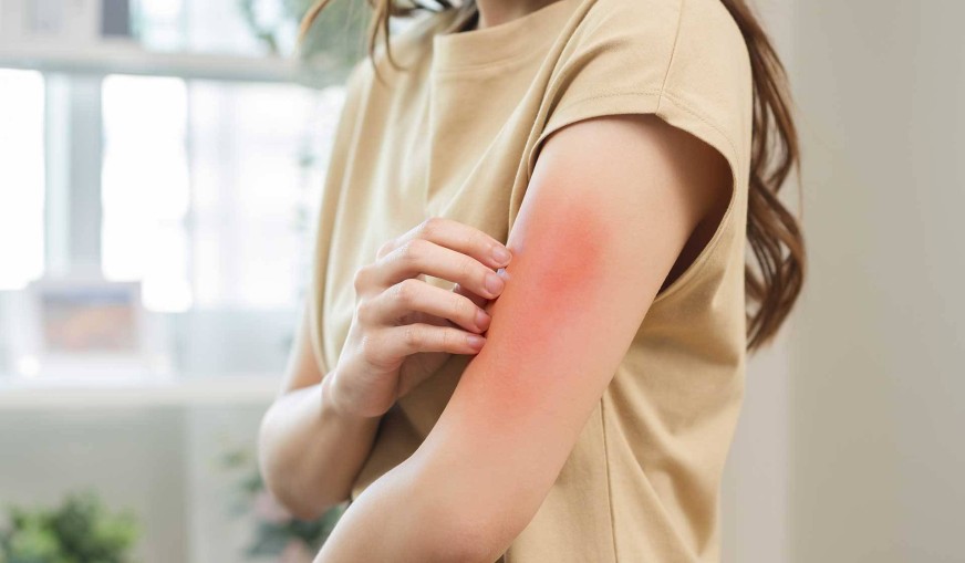 Besin Alerjileri ve İntoleransları: Beslenme Planınızı Nasıl Uyarlarsınız?