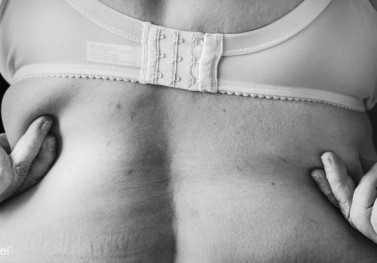 Ameliyatsız Bölgesel Zayıflama Yöntemleri