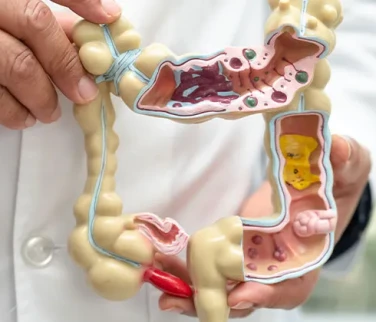 Crohn Hastalığı Beslenmesi: Alevlenme ve Remisyonda Ne Yemeli?