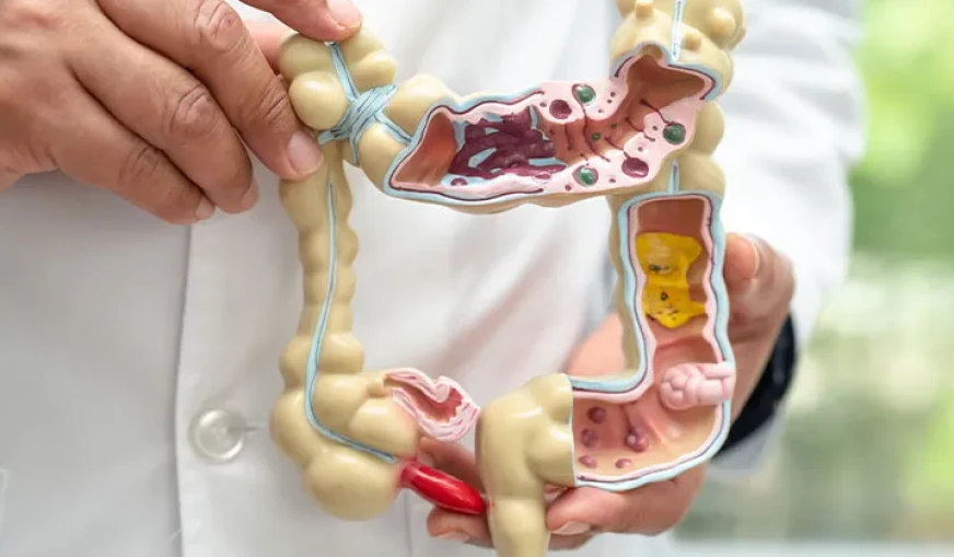 Crohn Hastalığı Beslenmesi: Alevlenme ve Remisyonda Ne Yemeli?