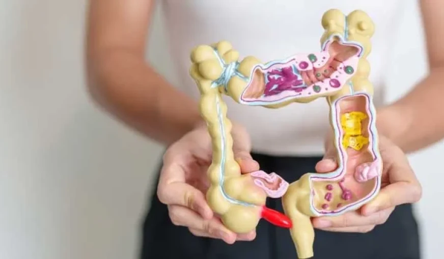 İrritabl Bağırsak Sendromu (IBS) İçin Beslenme Planı