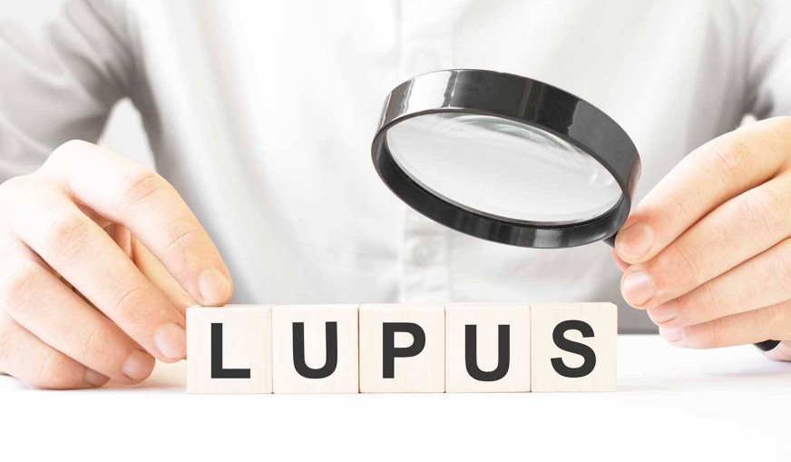 Lupus Hakkında Bilmeniz Gereken Her Şey