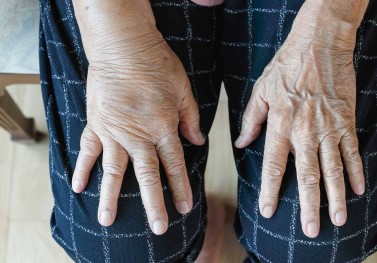 Ödem Nedir? Neden Olur?