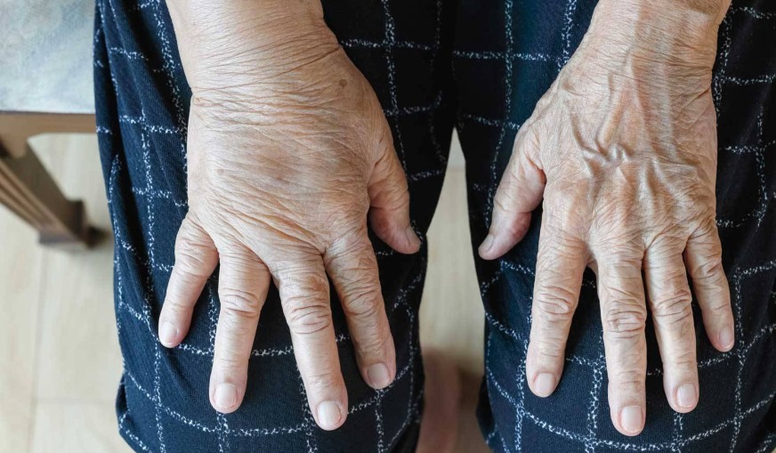 Ödem Nedir? Neden Olur?