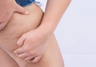 Micro Plus ile Selülit Tedavisi